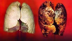 Sigara İçenlerin Akciğerlerini Temizleyen ve İyileştiren Doğal Çözümler