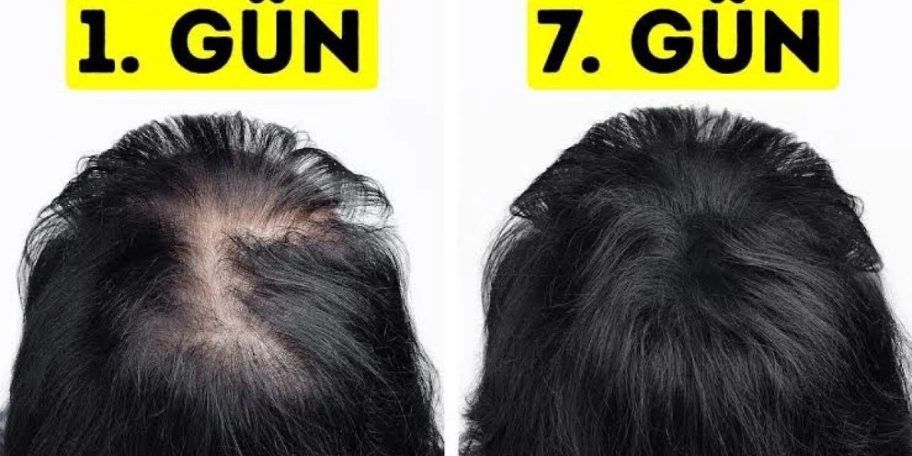 Muhteşem Sonuçlar Veren Doğal Yöntem! Artık Seyrek Saç ve Kellik Problemine Son: 7 Günde Saçlarınızı Yeniden Canlandırın!